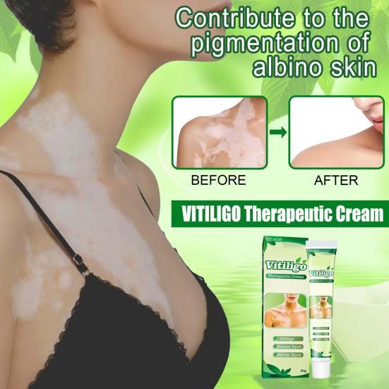 20 g White-Tag-Creme, einzigartige Verwendung von Pflanzenextrakten, therapeutische Vitiligo-Creme