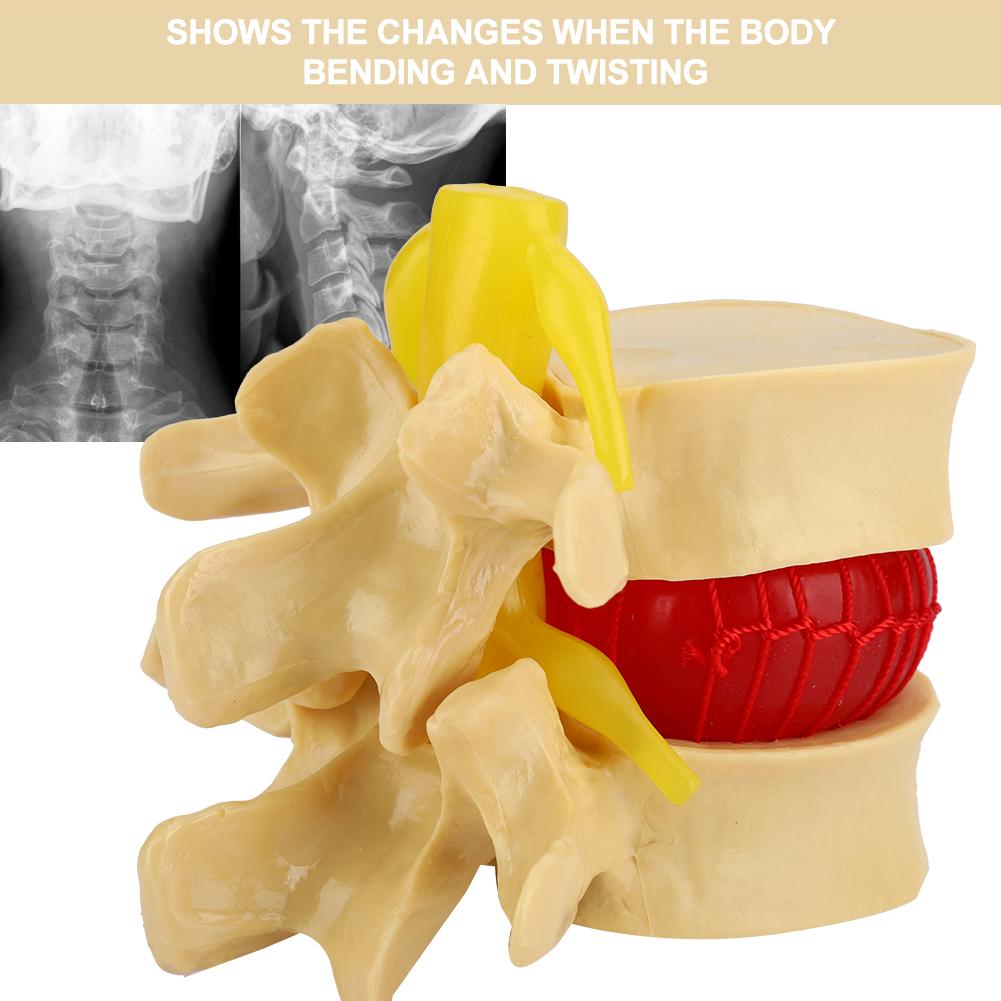 1:1.5 Lumbar Disc Herniation Demonstration Model Study Learn Human Spine