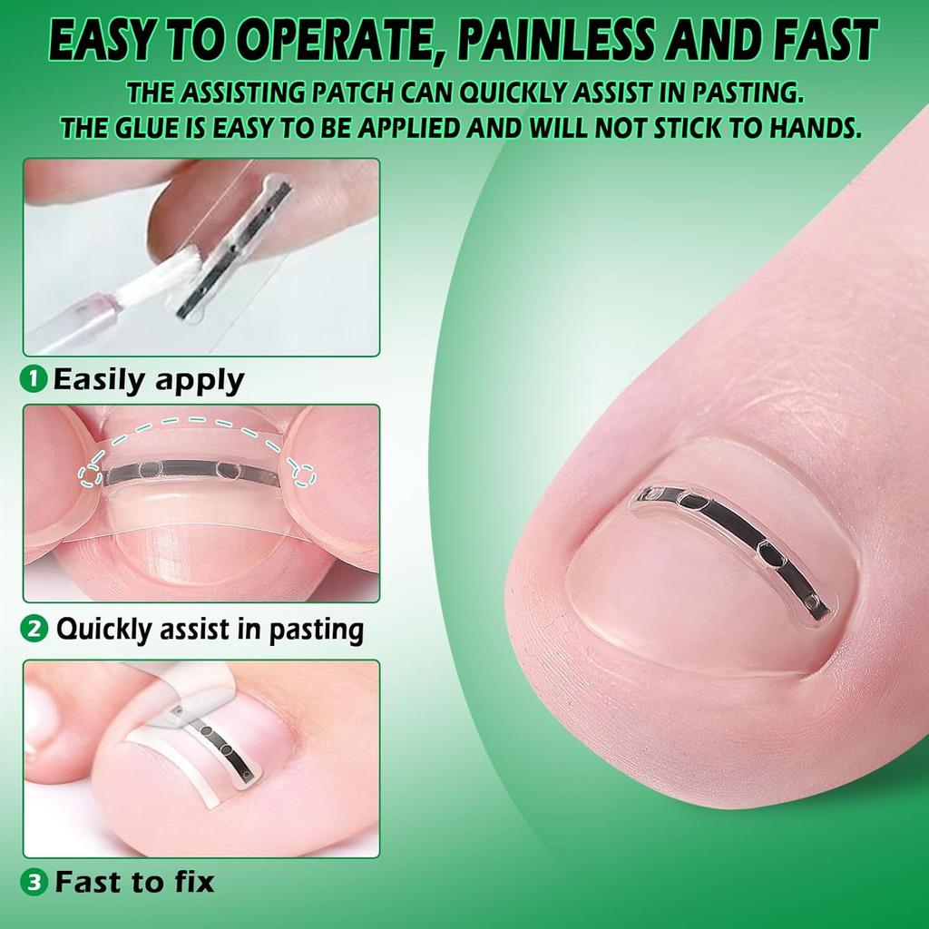 Entwickelt für die Reparatur gebogener Nägel und zur Korrektur eingewachsener Zehennägel, Nagelwerkzeuge und ein Set zur Entfernung eingewachsener Zehennägel