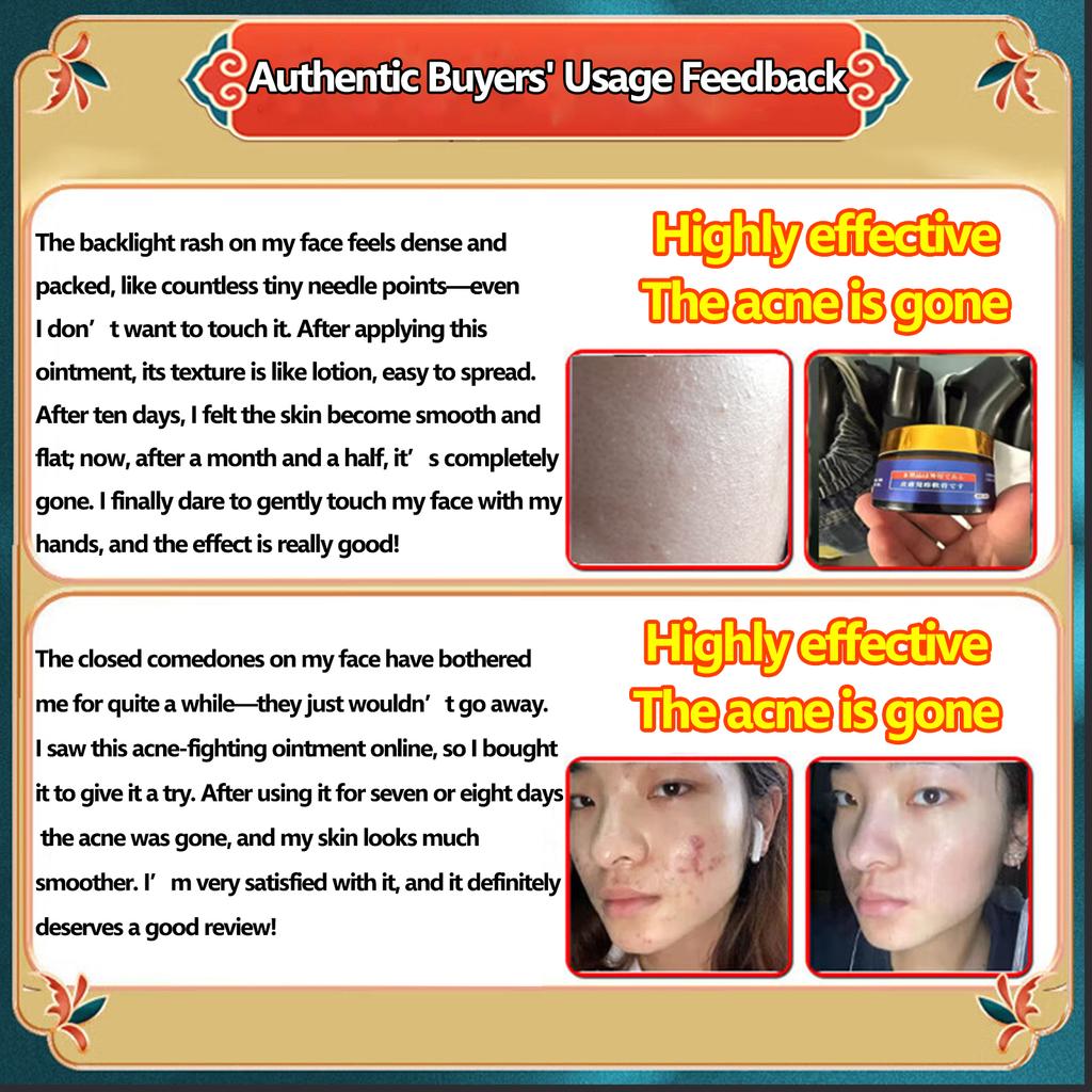 Acne-Clearing Cream-Natural Extraction+Pore-Shrinking+Blackhead-Removing,Acne-Prone Skin Daily Care & Post-Acne Pore/Blackhead Improvement