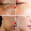 Dark Spots Remover Whitening Serum Face Freckle Melanin Correcting Reduce Fine Lines Brighten Essence Korean Beauty Skin Care