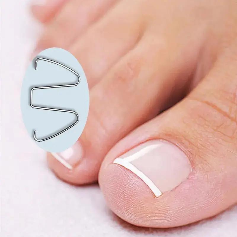 Nagelkorrekturdraht, Gerät zur Korrektur eingewachsener Nägel, Nagelschneiden, Korrekturdraht für eingewachsene Nägel, Zehennagelkorrekturhaken
