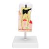 Dental Caries Tooth Model Dental Teeth Model for Teaching Training Patient Education