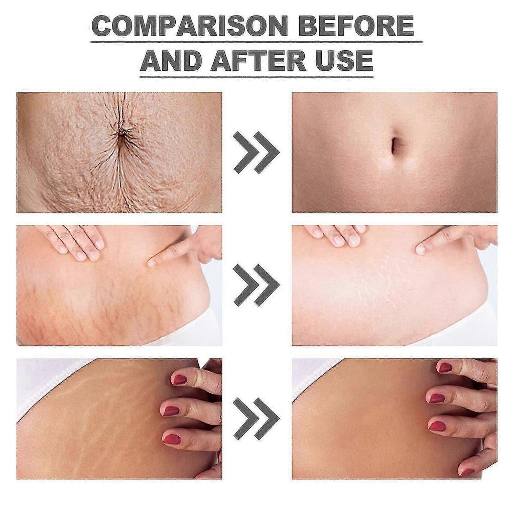 Wiieey Snail Essence Pregnancy Cream Firming Skin Repair Fading Postpartum Pregnancy Marks Pregnancy Obesity Wrinkle Cream Lotion & Moisturizer1pcs) -