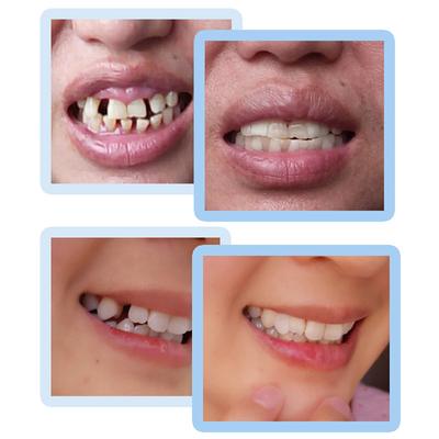 Κιτ Επισκευής Δοντιών 30ml Κενό Δοντιών Ψεύτικα Δόντια Στερεή Κόλλα Συγκολλητικό Εργαλείο Ομορφιάς