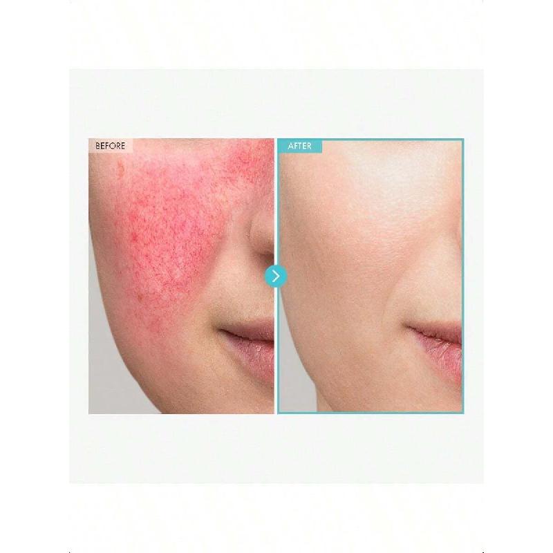 Tosowoong SOS Repair CICA Clinic Zinc Cream 50g | Ultra-High 100,000ppm Zinc Oxide Formula, Heals & Soothes Acne, Redness & Rosacea