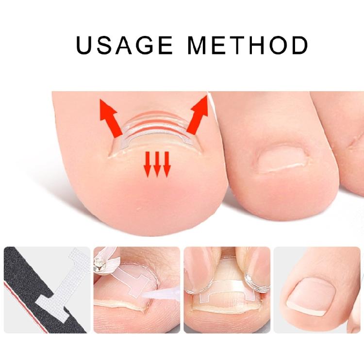 Ingrown Toenail Corrector Patches,Ingrown Toenail Treatments Tool Foot Care,10pcs Ingrown Toenail Corrector Strips