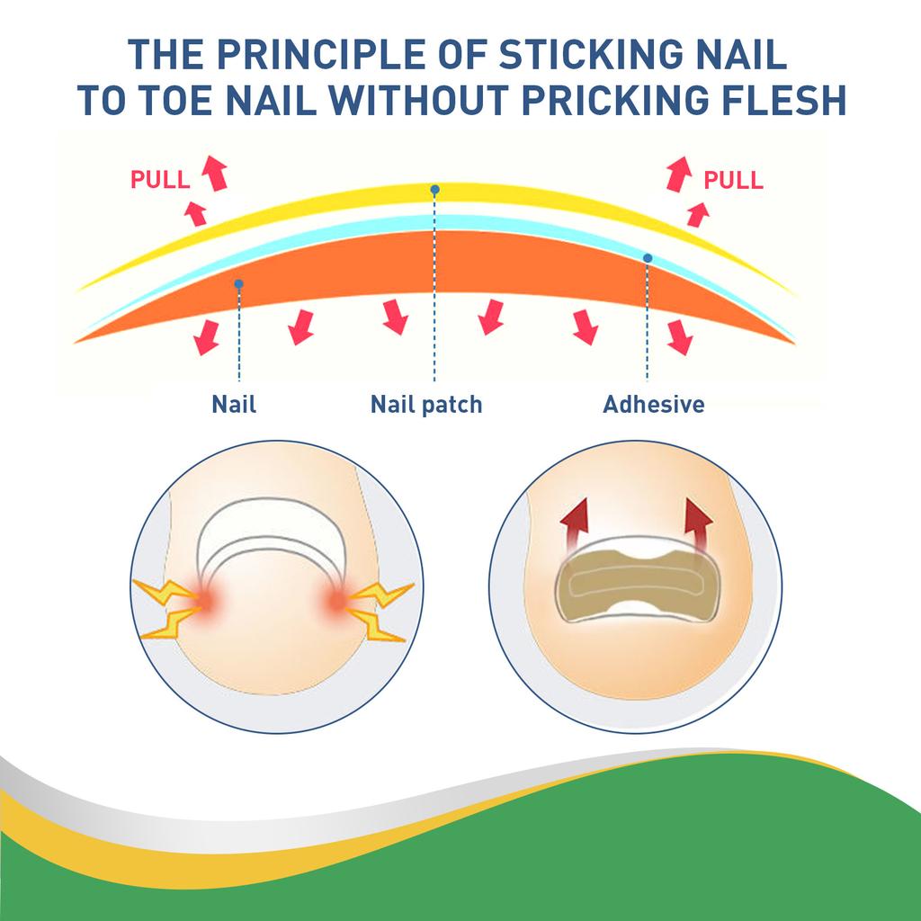 50 Pcs/Set Nail Ingrown Stickers Double-sided Adhesive Ingrown Toenail Correction Ingrown Toenail Correction Tool Elastic Patch Stickers