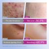 SADOER Colorful Star Acne Patch Student Acne Removal Acne Repair Patch