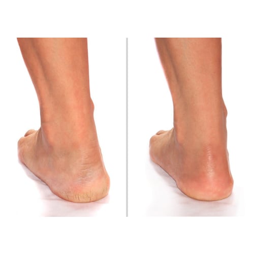 Advanced Clinicals Cracked Heel Cream for Dry, Rough Spots, Calluses by Advanced Clinicls