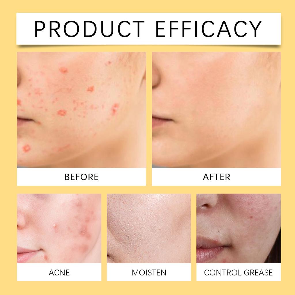 The Skin Cream For Removing s, Combined With Herbal Ingredients, Can Remove s Without Leaving Scar.