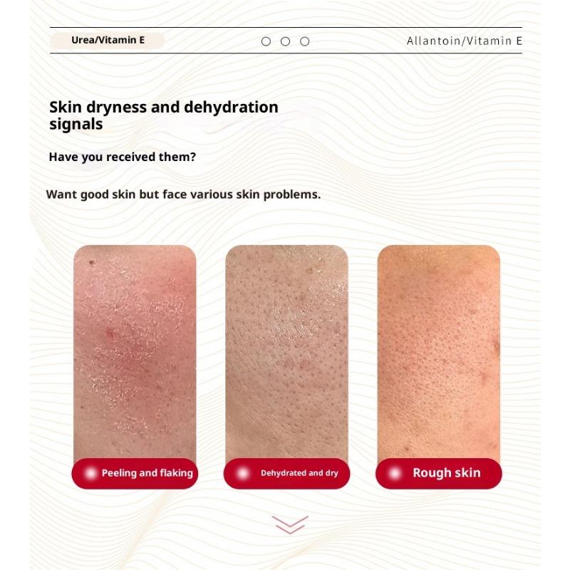 Urea Vitamin E Cream Moisturizing Cream To Improve Blackhead Acne