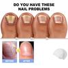A04V Lasers For Nail Fungus Treatment Device Onychomycosis Cleaning Foot Repair Fungi Fungal For Nails Removal Anti Mushroom