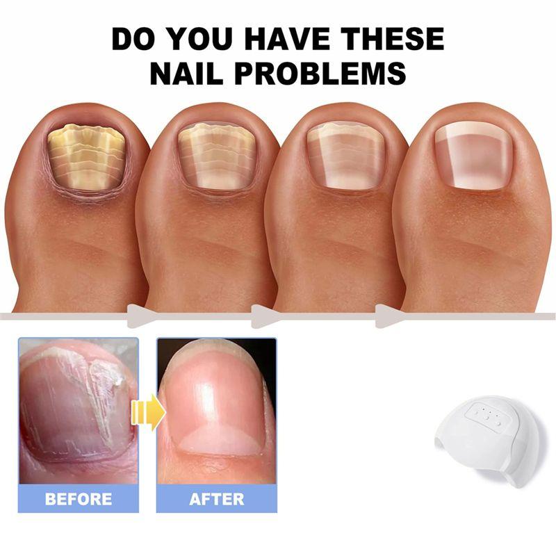 A04V Lasers For Nail Fungus Treatment Device Onychomycosis Cleaning Foot Repair Fungi Fungal For Nails Removal Anti Mushroom