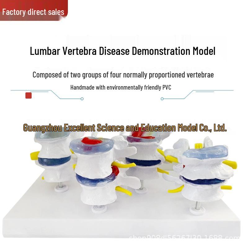 Four-Part Lumbar Spine and Lesion Model - Anatomical Human Skeleton Pathology Joint