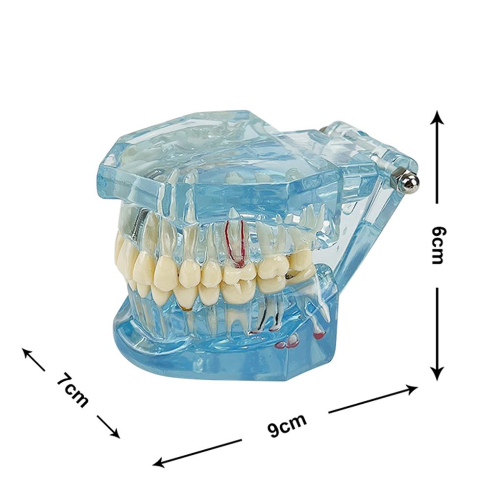 Teeth Model Implant Disease Dentist Studying Model With Restoration Bridge Tooth Demonstration Models For Patient Education