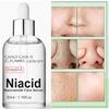 Zenvick Natural Niacid Face Serum - 10% Niacinamide for Acne Marks, Blemishes & Oil Control with Zinc Skin Clear Anti Acne Serum for Oily
