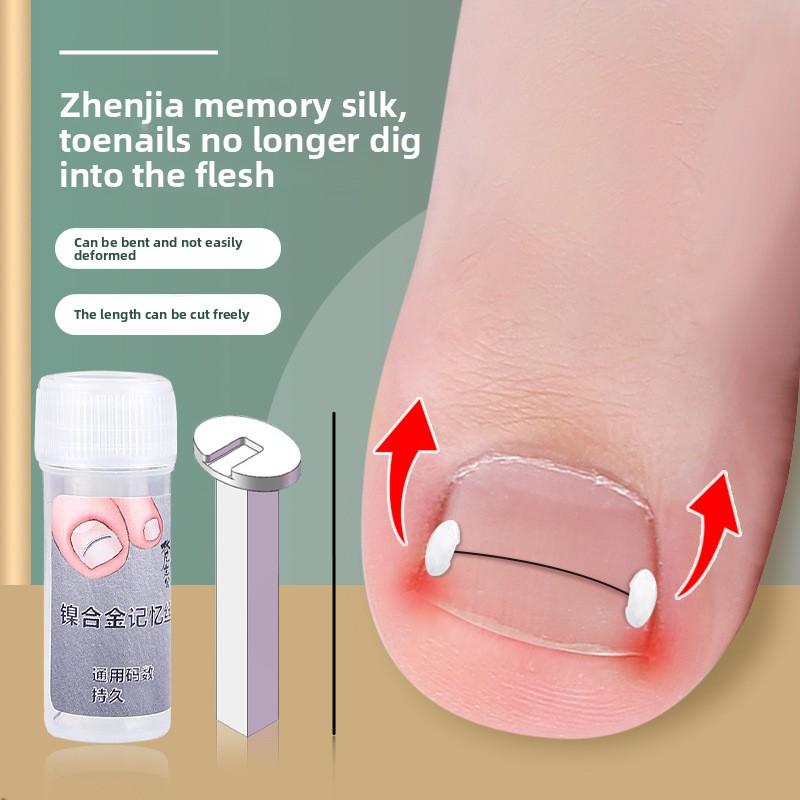 Lockige Nagelorthese Nickel-Chin-Legierung Memory-Rückprall Positiver Nagelkleber Nagelfalz Eingelegter Nagel Positiver Nagelpflaster Zehennagel Langes Fleisch