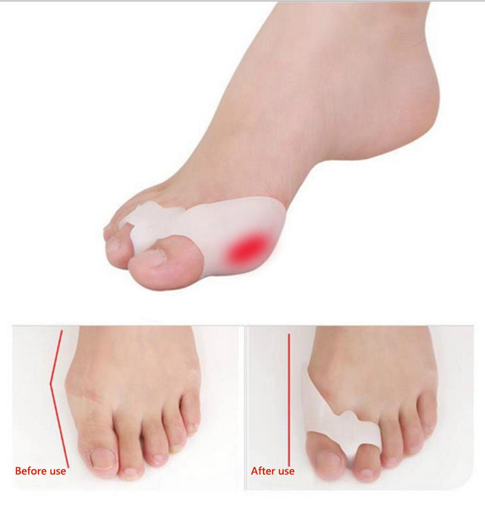 Silikon Zehenspreizer Schiene – Großzehen Überlappungskorrektor & Fußorthese (1 Paar)