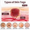 Skin Tags Removal Cream, Black Rice Exfoliating Treatment for Women & Men, Dual - Action Exfoliation & Brightening