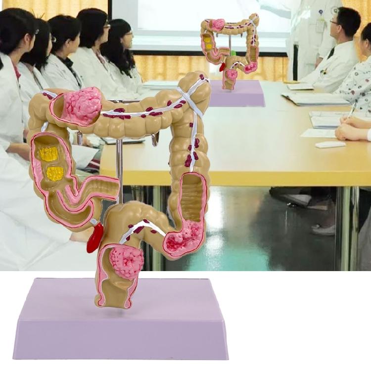 Pathologien des Dickdarms beim Menschen Modell Medizinisches Lehrmittel Modell des menschlichen Dickdarms Modell der menschlichen Anatomie