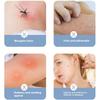 Portable Mosquito Insect Bite Relieve Itching Pen Natural Mosquito Bite Heat Pen Chemical-Free Anti-Itch Pen for Adult Children