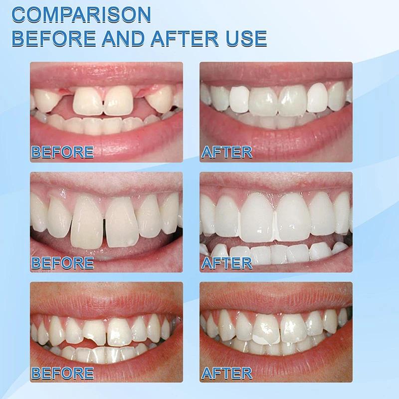 10g50g/30ml Resin Tooth Repair Glue Shapeable Teeth Gaps Filling Solid Glue Temporary Teeth Repair Falseteeth Glue Safety Dental