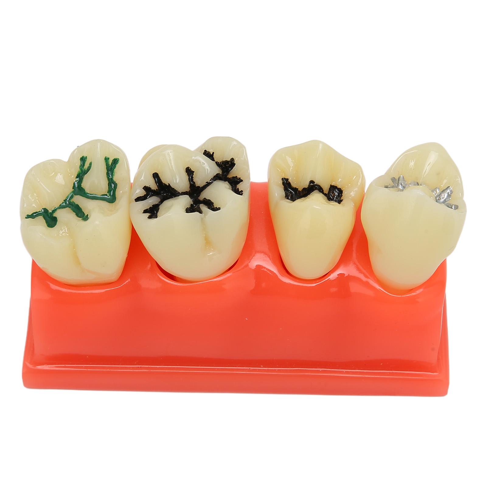 

Модель зубного кариеса из смолы 4 зуба Уход за полостью рта Образовательная Модель для демонстрации разрушенного зуба для стоматологии