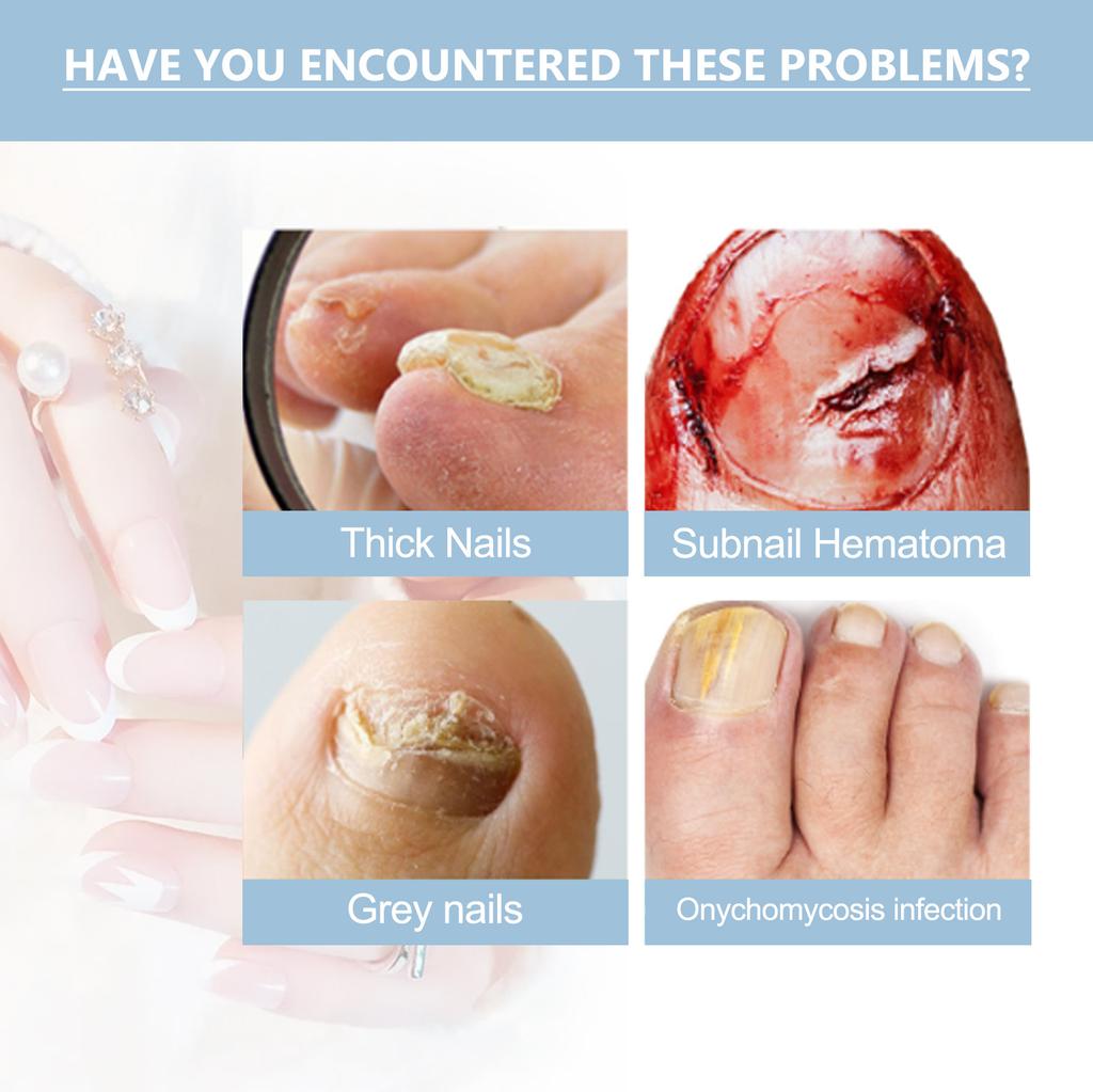 15ml  Cracked Nail , Nail Strengthener For Damaged Nails, Yellow Toenail , Nail Strengthener And Growth, Nail Kit For Cracked Natura