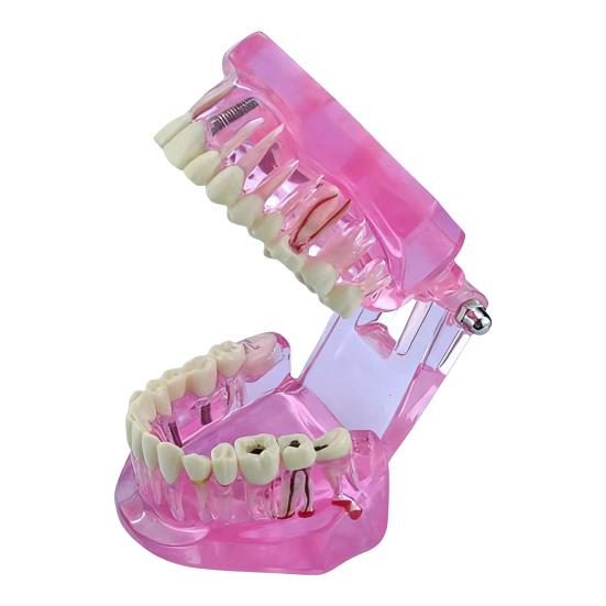 Dental Implant Model Teaching Aid for Dentist Student School Removable Teeth