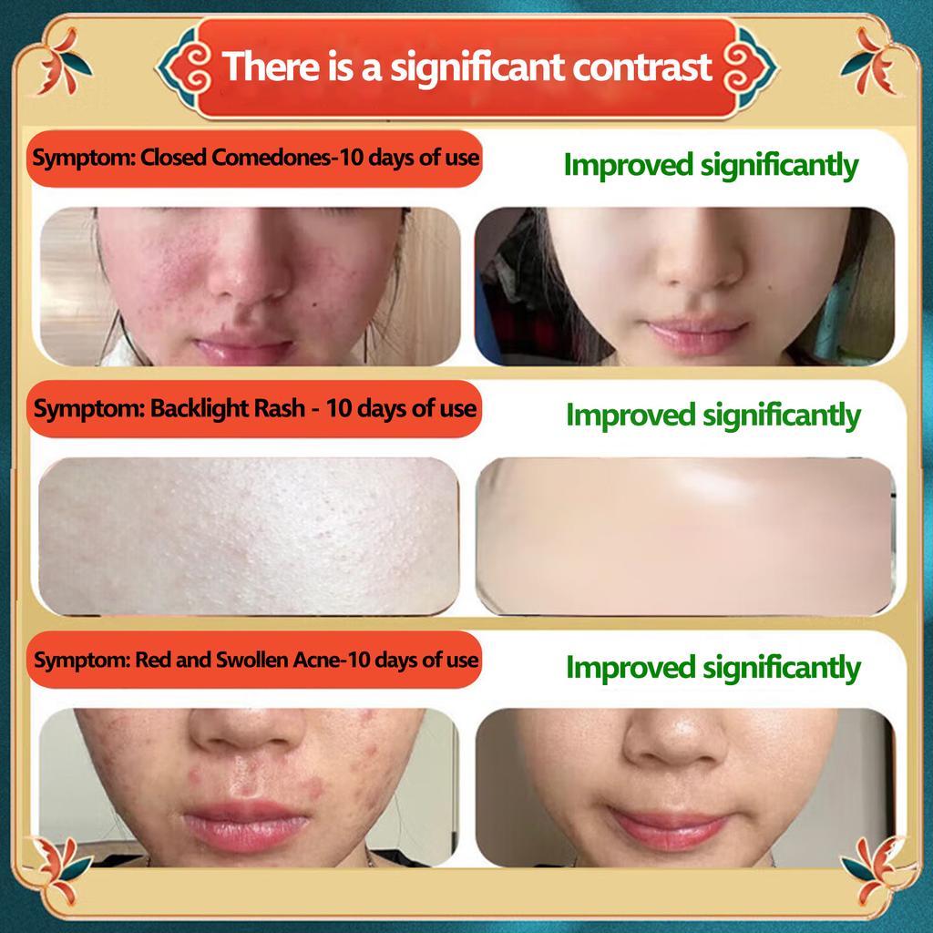 Acne-Clearing Cream-Natural Extraction+Pore-Shrinking+Blackhead-Removing,Acne-Prone Skin Daily Care & Post-Acne Pore/Blackhead Improvement