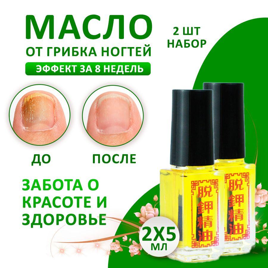 5ml Nail Removal Oil For Onychomycosis