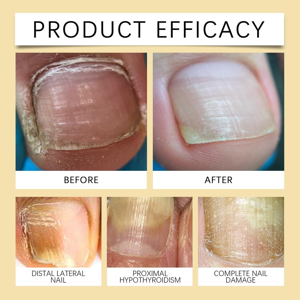 Nail Pen, Nail , Hand And Foot Nail Care, Nail Week Care, Gentle And Nourishing, Shiny Nail 2ml