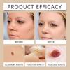 Verruca Care Cream Gentle Cleansing, Moisturizing And Softening The Skin, Reducing Skin Discomfort.