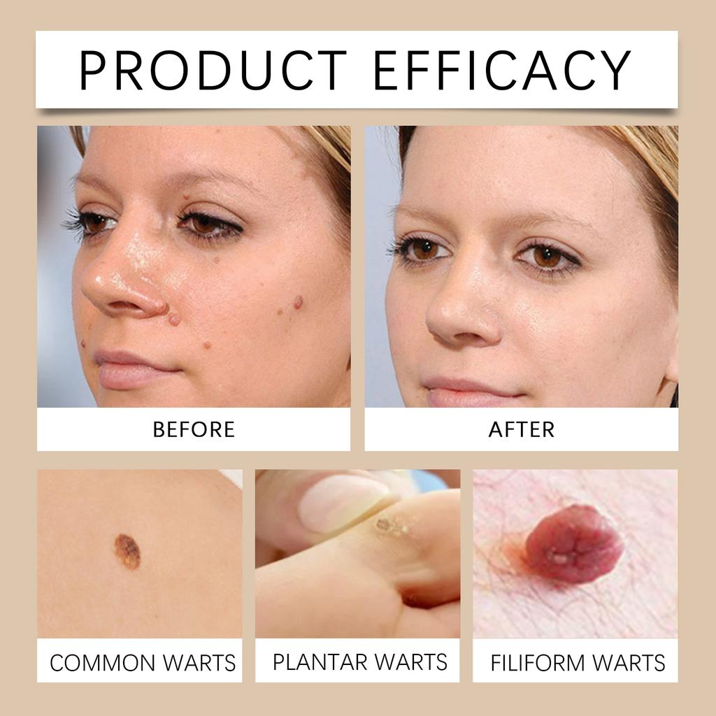 Verruca Care Cream Gentle Cleansing, Moisturizing And Softening The Skin, Reducing Skin Discomfort.