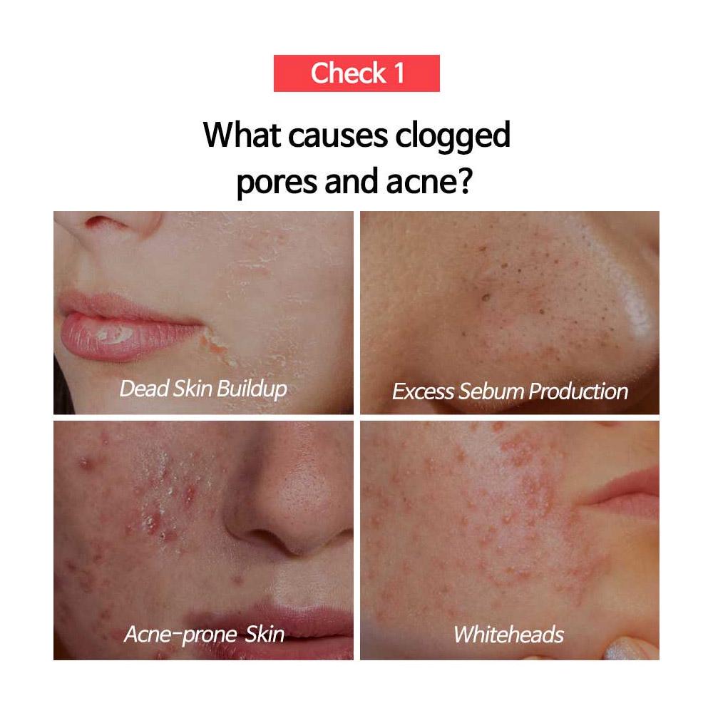 yuja niacin for acne