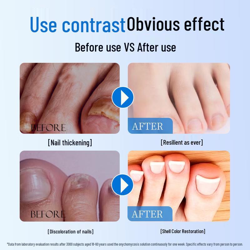 Layanana Fungal Infection Treatment