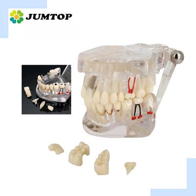 Removable Teeth Model Implant Disease Dentist Studying New Dental Model Teeth Implant Restoration Bridge Teaching Demonstration