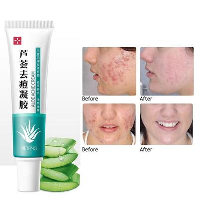 Creme Antiacne com Extrato de Aloe Vera Creme Encolhedor de Poros 30g