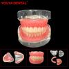 Educational Dental Implant Model Removable 4 Implant Upper Lower Jaw Models Dentist Maxillary Mandibular Overdenture Teeth Model