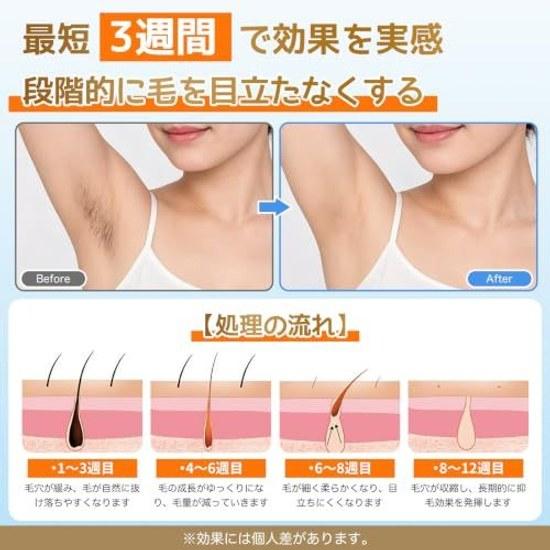 Hair Removal Device VIO Compatible IPL Light Beauty Beard Unisex High Power Design 5 Adjustable Levels Automatic Continuous Emission 990000 Long-life