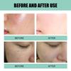 Acne Cream, Facial Cleansing And Acne Cleansing Cream, Gentle Acne Removing And Brightening Facial Skin Care Cream