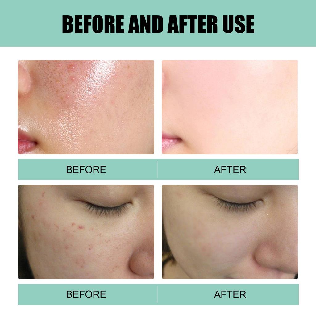 Acne Cream, Facial Cleansing And Acne Cleansing Cream, Gentle Acne Removing And Brightening Facial Skin Care Cream