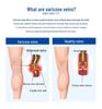 Varicose Vein Relief Compression Socks - Level 3 Open Toe Anti-swelling Long Socks