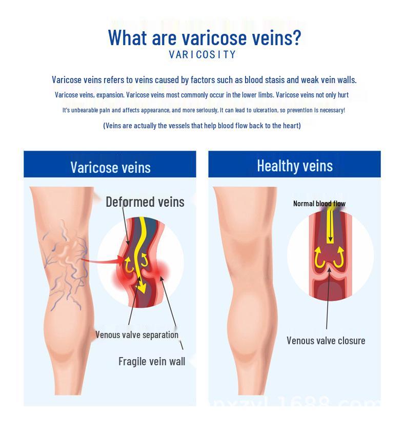 Varicose Vein Relief Compression Socks - Level 3 Open Toe Anti-swelling Long Socks