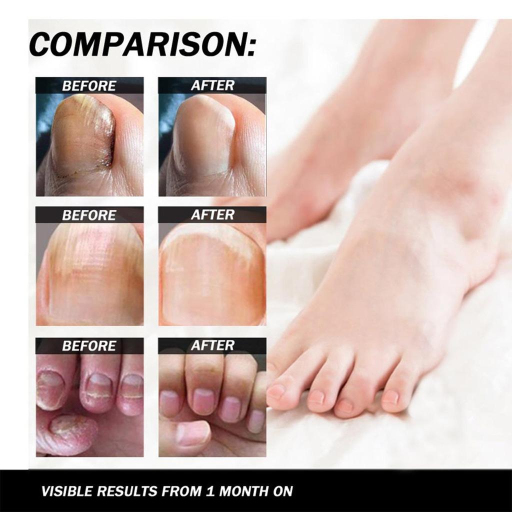 Gyors körömgomba kezelés, körömkarbantartó körömápoló folyékony kezelés, lábgombásodás 30ml