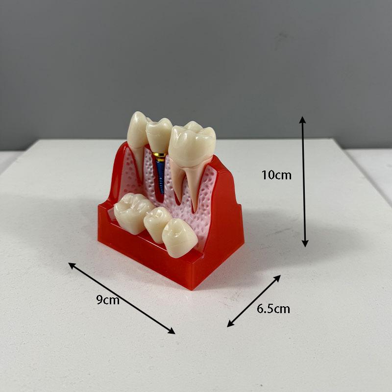 Прозора Знімна Повна Модель Щелепи з М'якими Яснами та Зубами для Підготовки до Імплантації