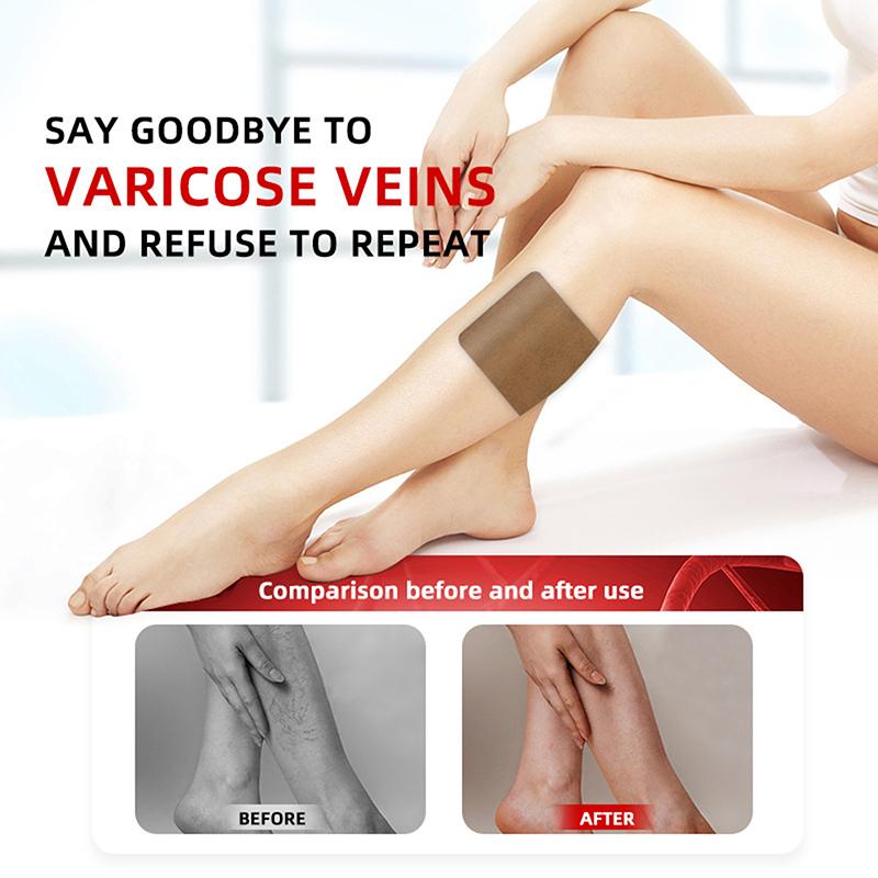 6 Patches/Pack Varicose Vein Patch External Plaster Shu Ning Patch Breathable Long-Lasting Soothing Spider Leg Vein Care Patches