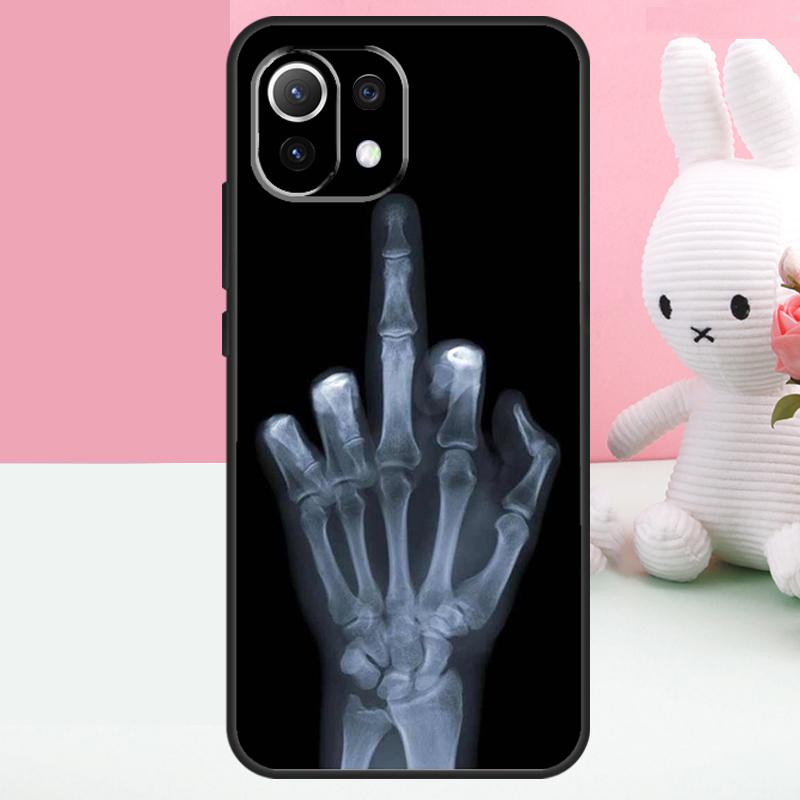 Skeleton Middle Finger Case For Xiaomi 15T 13T 14T 17 Pro Max 15 14 Ultra POCO X7 Pro X5 X6 F5 F6 F7 F8 Ultra Funda