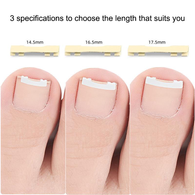 1Pcs Ingrown Toenail Corrector Tools Pedicure Recover Embed Toe Nail Treatment Professional Ingrown Toenail Correction Foot Care